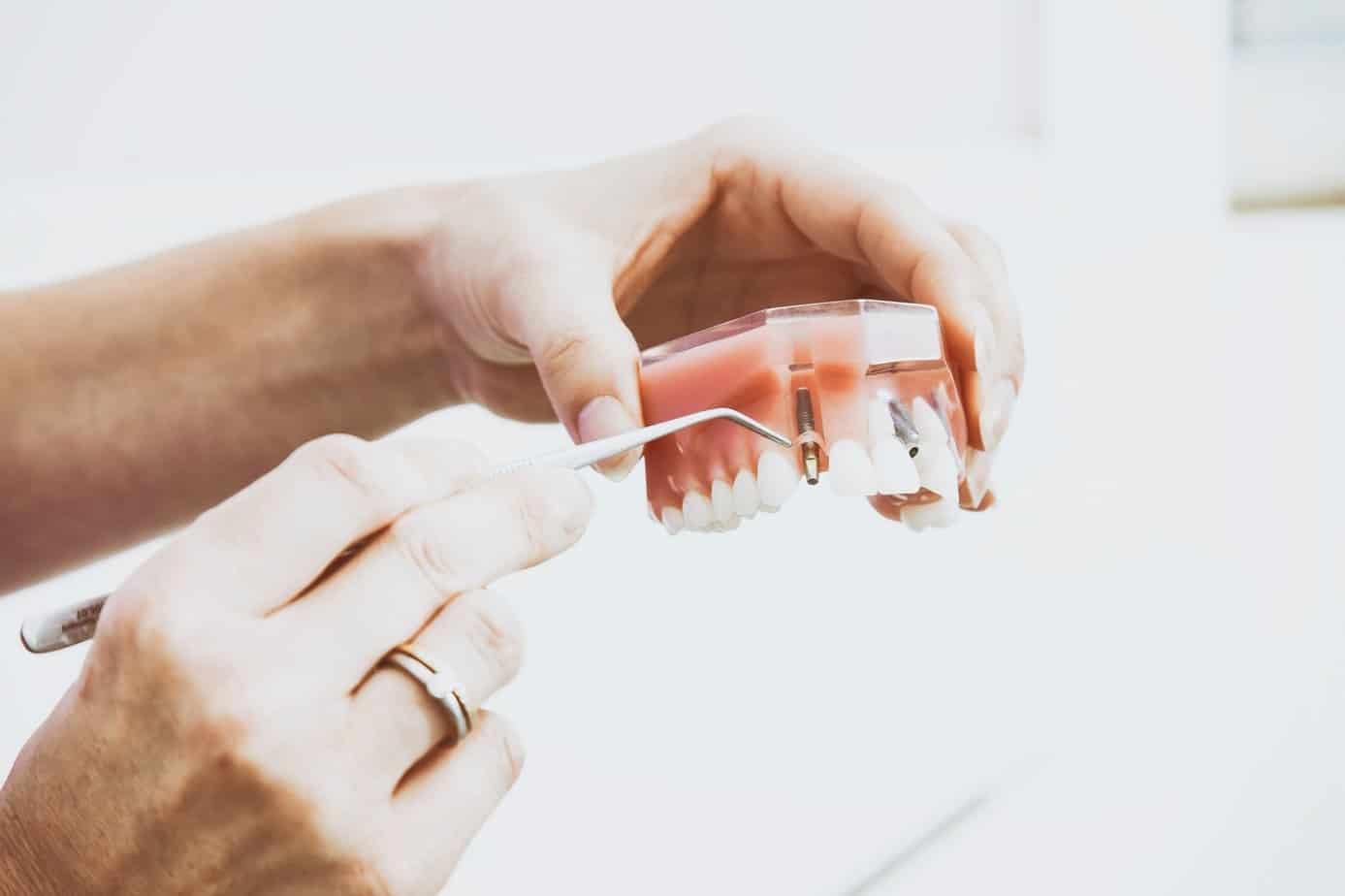 Kiedy i jak wszczepia się implanty zębowe?